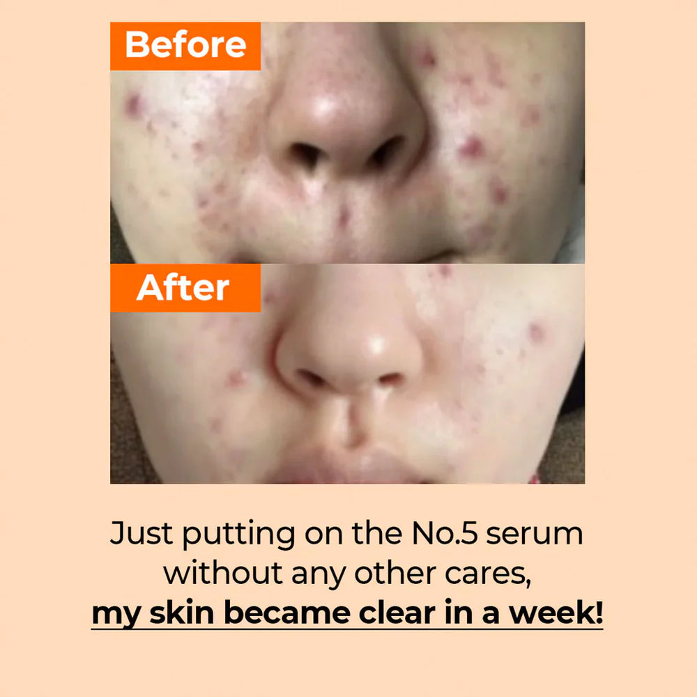 5_Goodbye_Blemish_Serum_info6-_Seoulful_Skincare