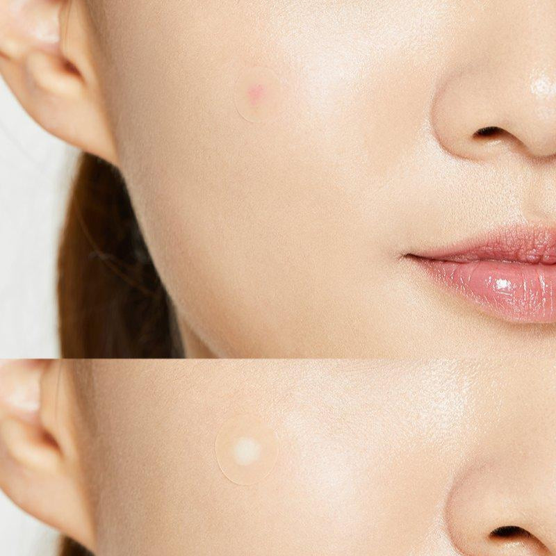 Cosrx - Acne Pimple Master Patch (24) - v3 - Seoulful Skincare
