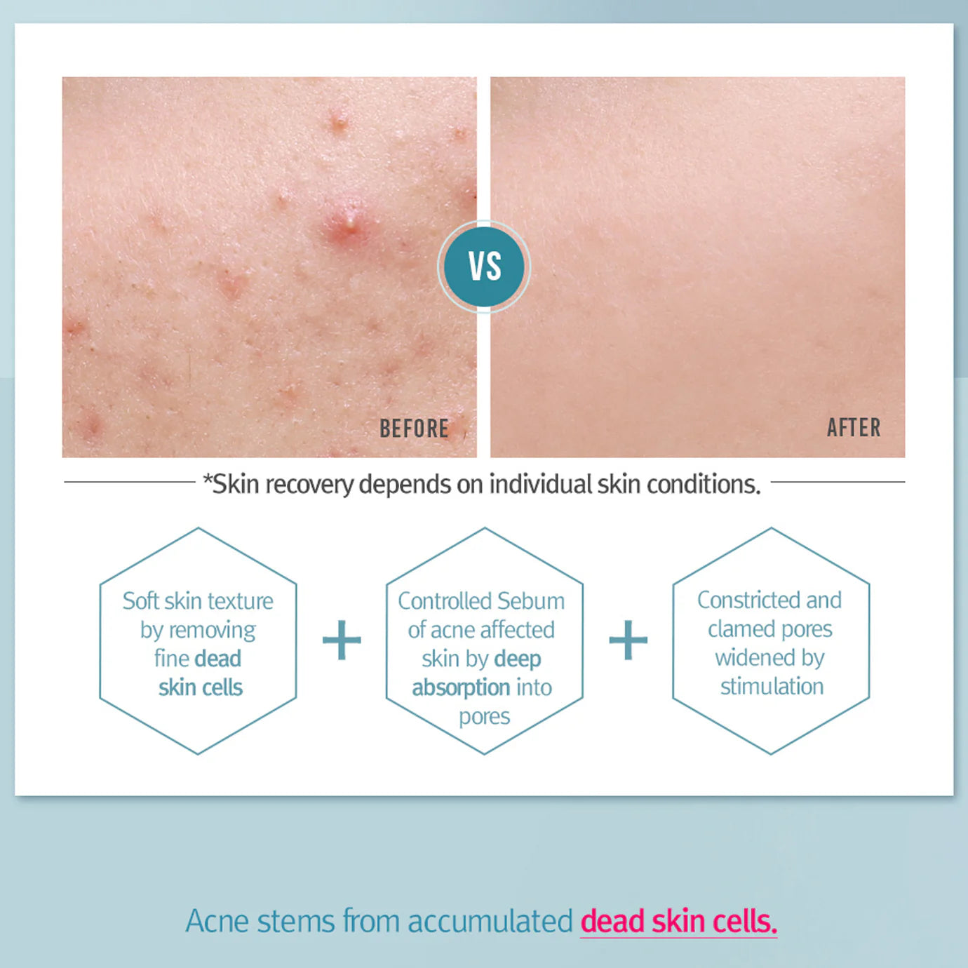 Pyunkang_Yul_-_ACNE_Toner_150ml_Info4-_Seoulful_Skincare