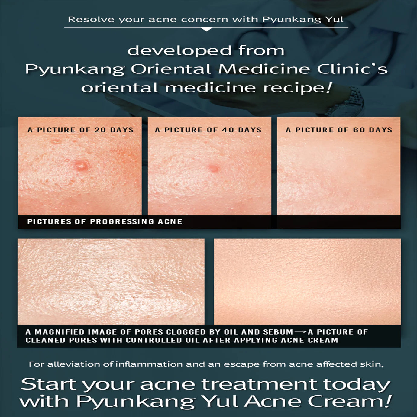 Pyunkang_Yul_-_ACNE_Cream_50ml_Info4_Seoulful_Skincare